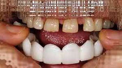 مراحل انجام اسنپ اسمایل در دندانپرشکی 