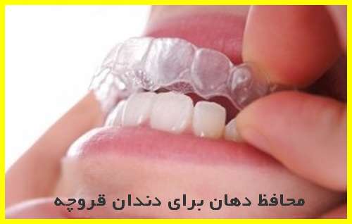 محافظ دهان برای دندان قروچه