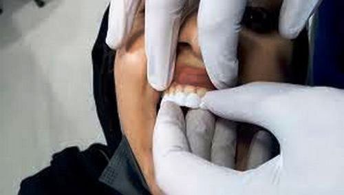  لمینت متحرک دندان اسنپ اسمایلدندان پزشکی