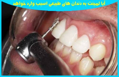 آیا لمینت به دندان های طبیعی اسیب وارد خواهد 