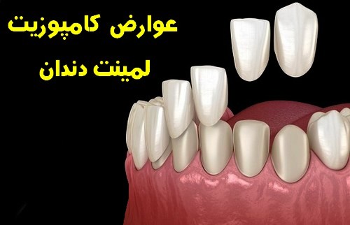 عوارض  کامپوزیت لمینت دندان چیه