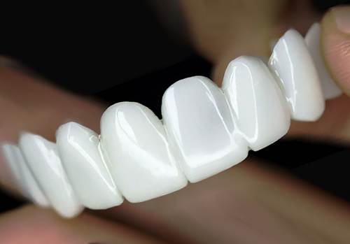 قیمت لمینت متحرک دندان چگونه تعیین میشود 