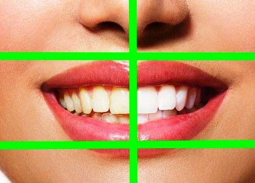 کامپوزیت دندان چگونه بر سلامت و زیبایی نقش دارد 