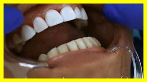 مراحل نصب لمینت دندان 