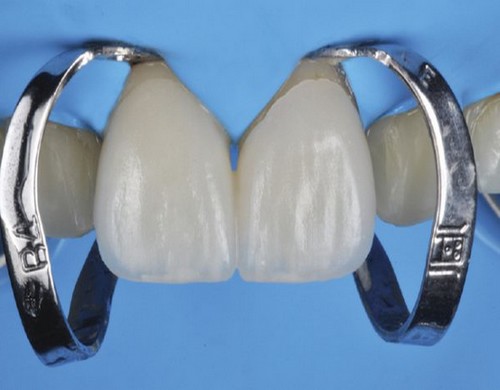معایب لمینت دندان سرامیکی چیست 