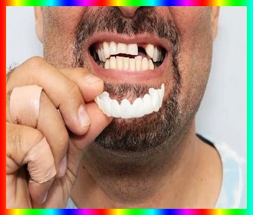 لمینت اسنپ اسمایل  دندانپزشکی چگونه روی دندان قرار میگیرد 