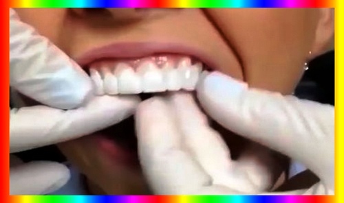 معایب لمینت موقت دندانسازی چیست 